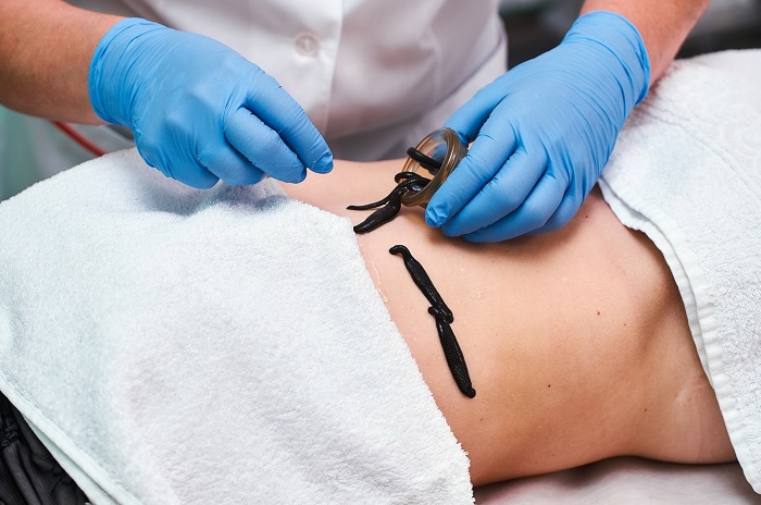 Пиявка медицинская: основные достоинства и правила применения